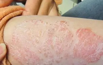 如何预防手部牛皮癣